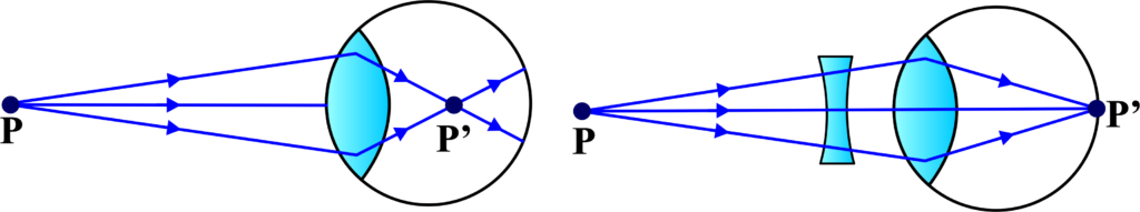 shortsighted or myopic eye and its correction