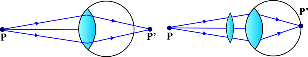 farsighted or hypermetropic eye