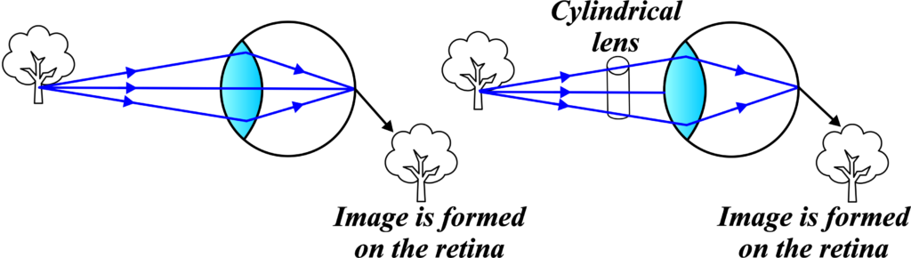 astigmatic eye and its correction